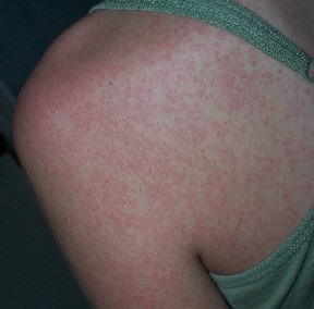 m_dengue-rash-16a99.jpg